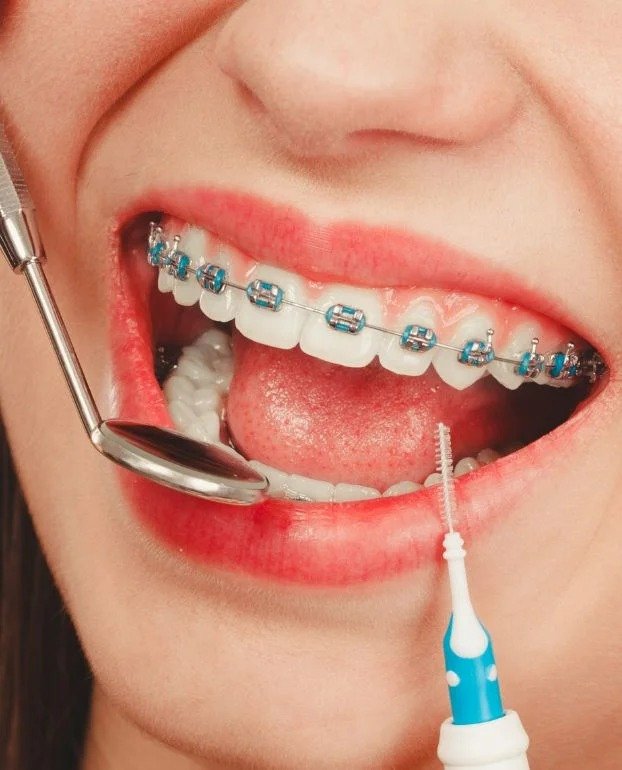 Braces in Northampton