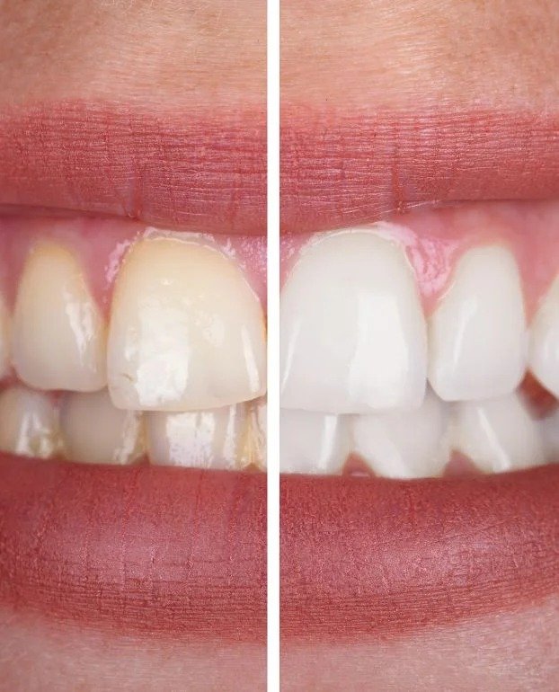 Teeth Cleaning Northampton
