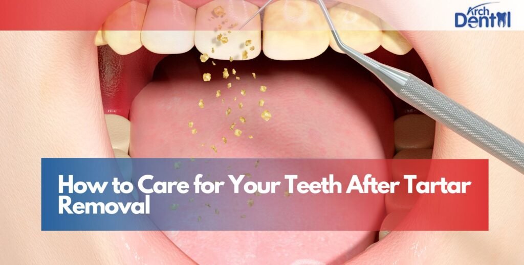 How to Care for Your Teeth After Tartar Removal