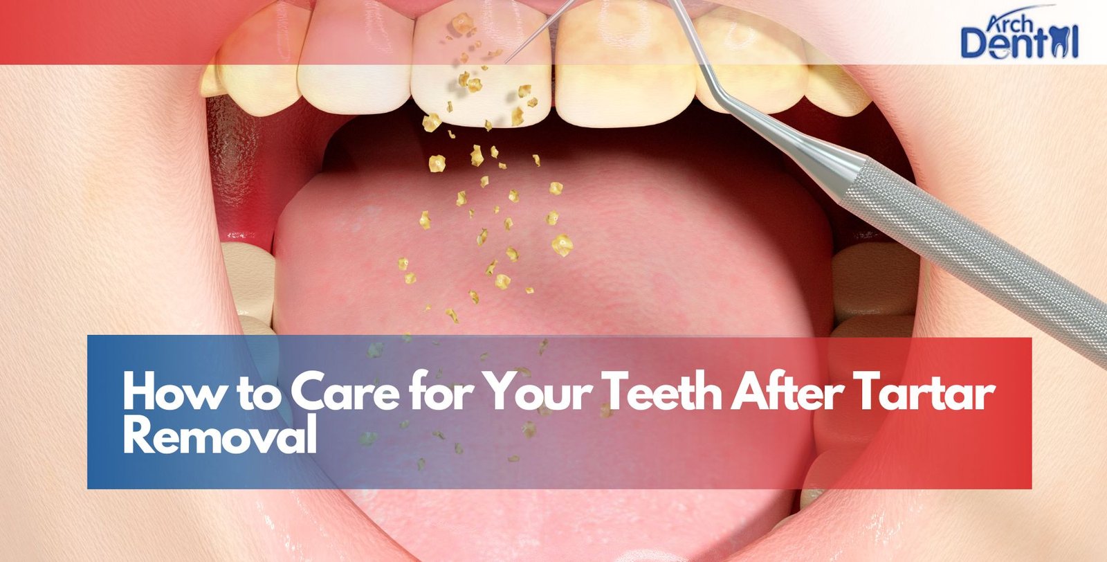 How to Care for Your Teeth After Tartar Removal