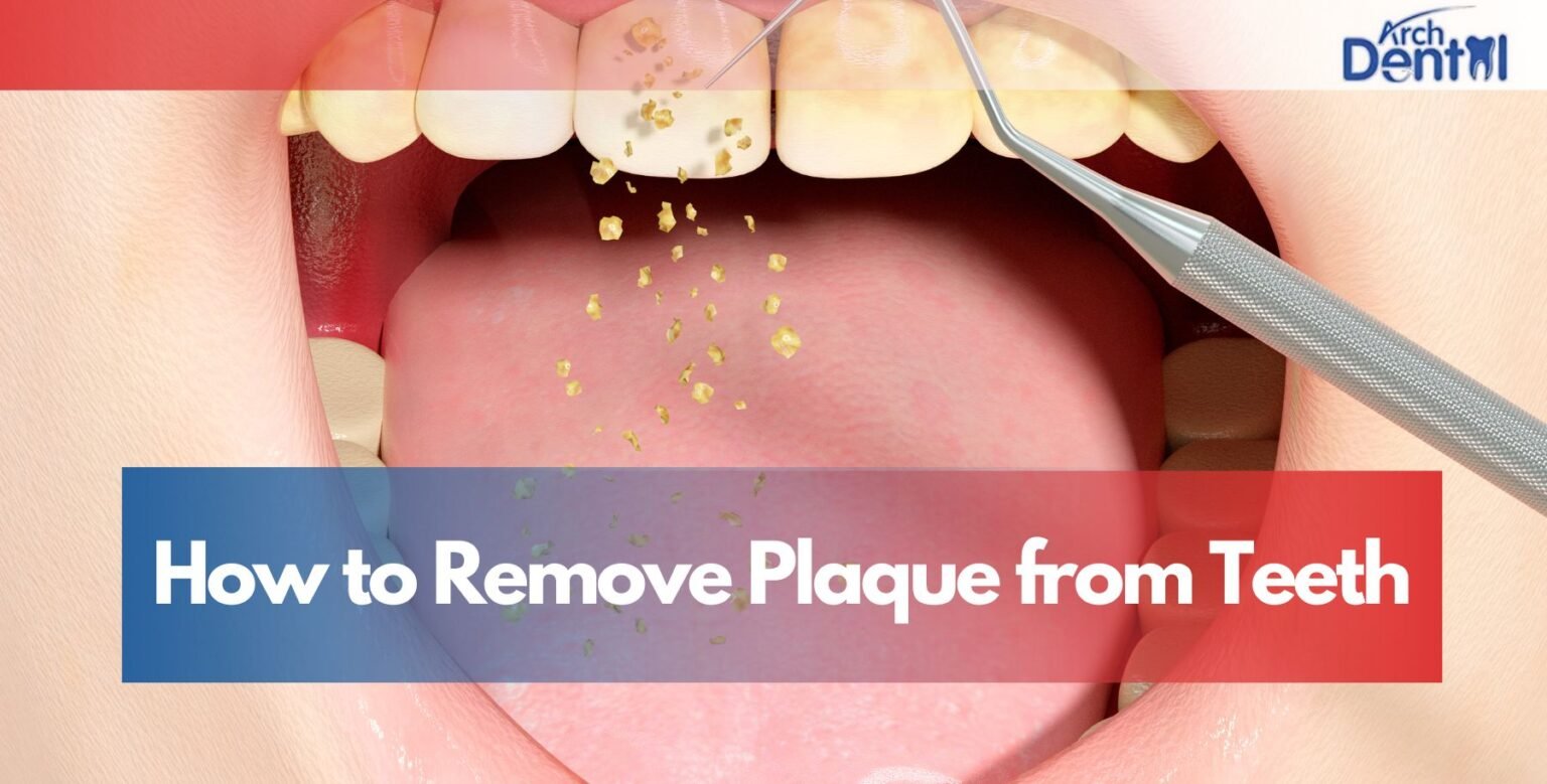 How to Remove Plaque from Teeth | Arch Dental