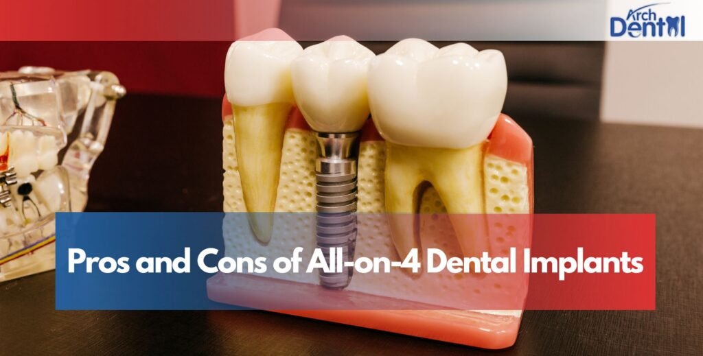 Pros and Cons of All-on-4 Dental Implants