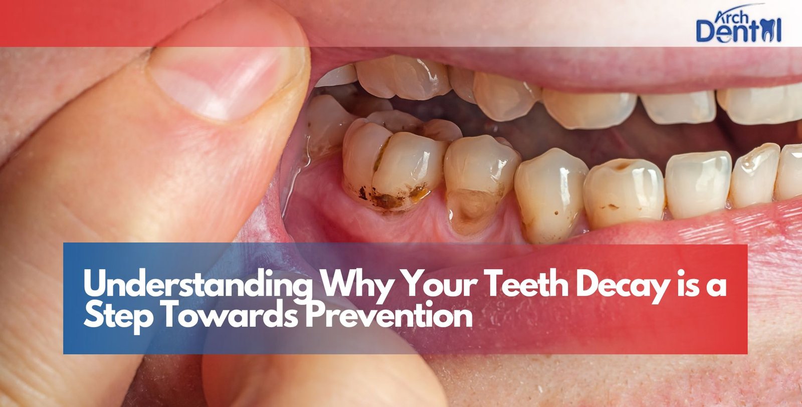 Understanding Why Your Teeth Decay is a Step Towards Prevention