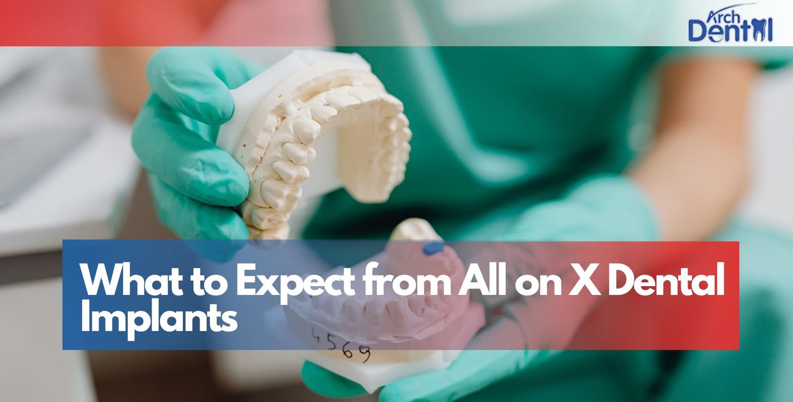 What to Expect from All on X Dental Implants