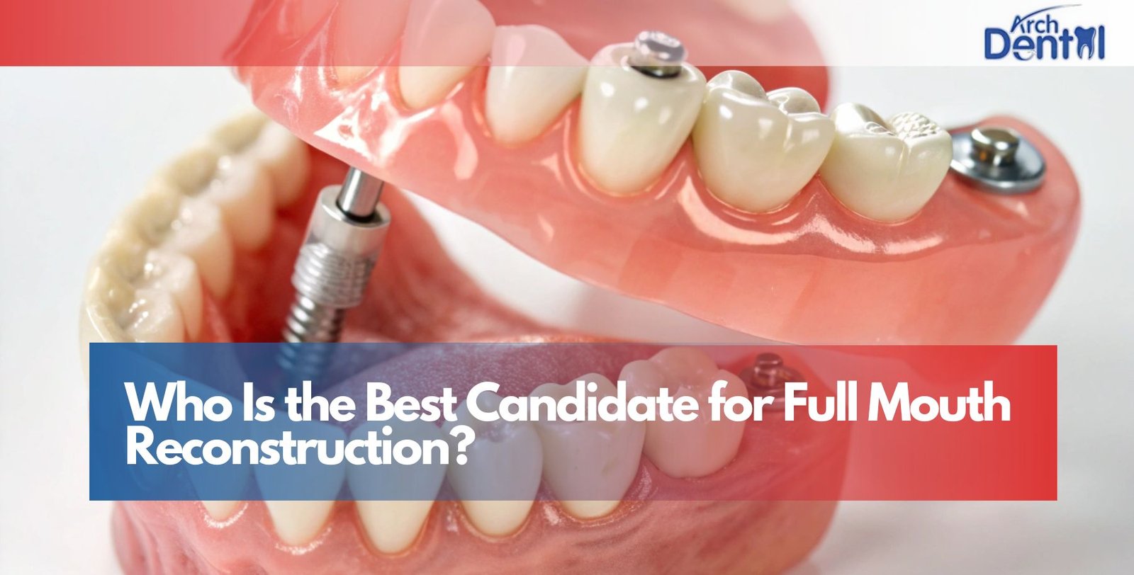Who Is the Best Candidate for Full Mouth Reconstruction