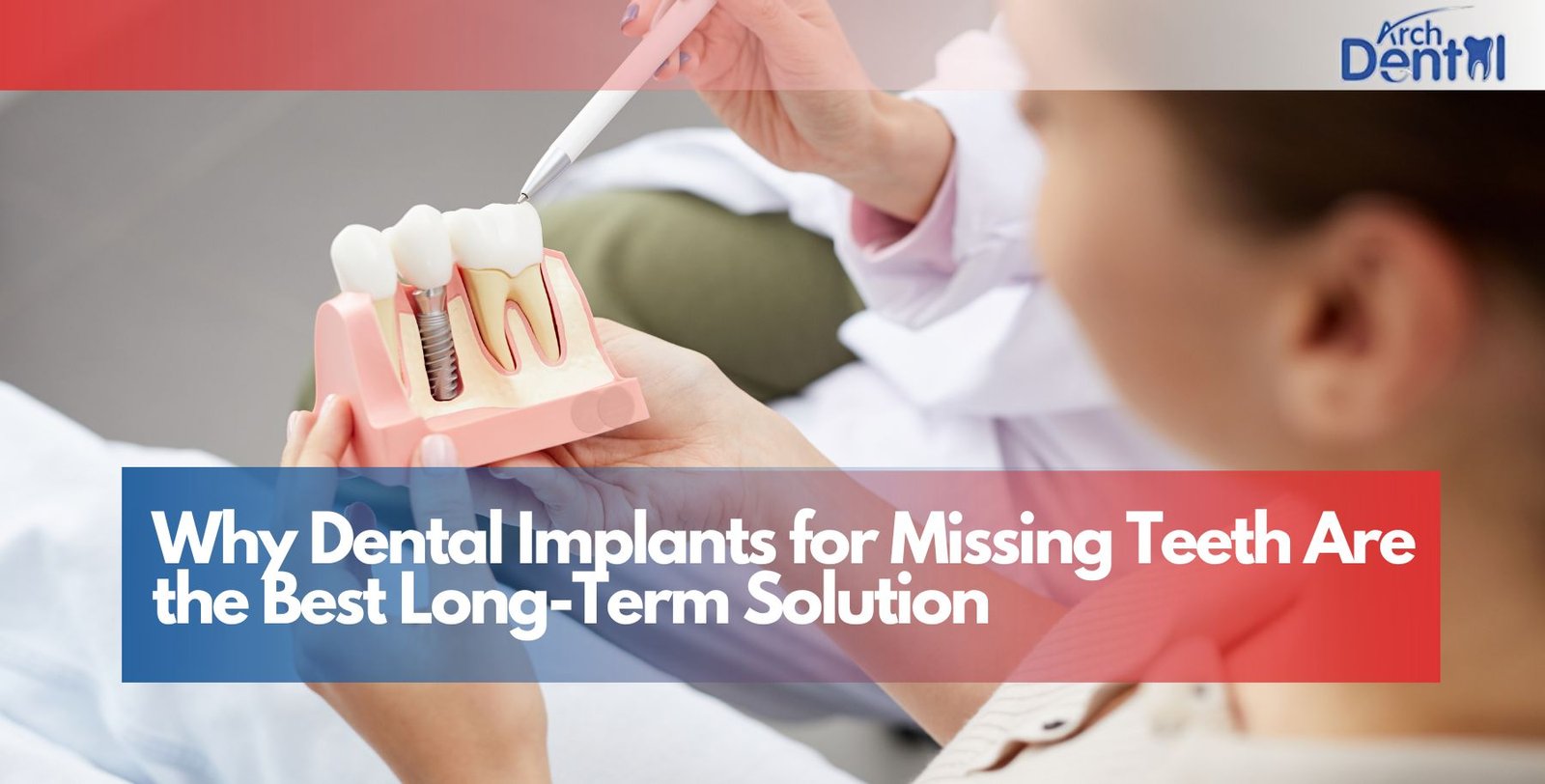Why Dental Implants for Missing Teeth Are the Best Long-Term Solution