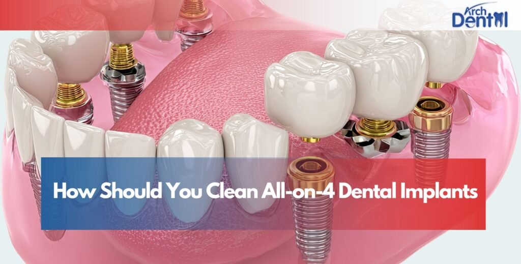 How Should You Clean All-on-4 Dental Implants