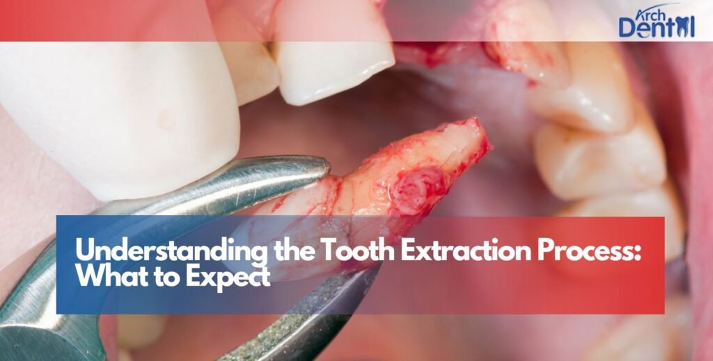 Understanding the Tooth Extraction Process