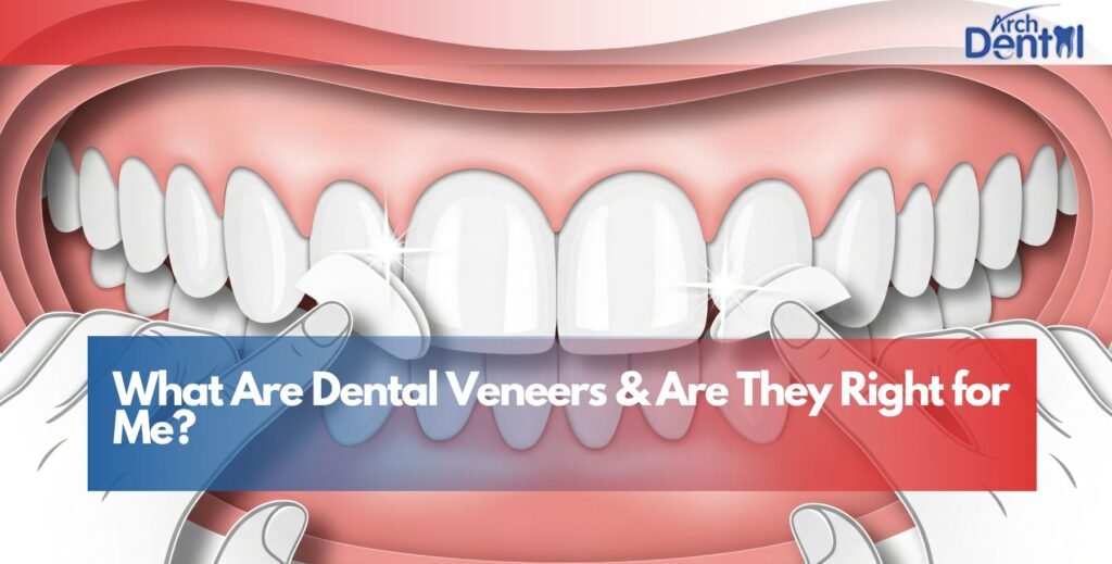What Are Dental Veneers & Are They Right for Me