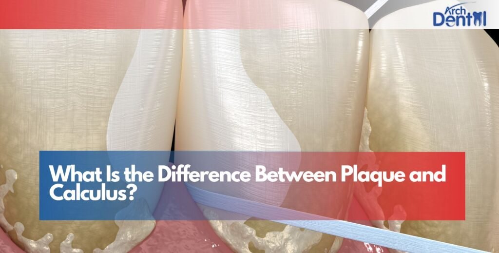 Difference Between Plaque and Calculus