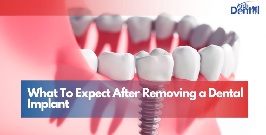 What To Expect After Removing a Dental Implant