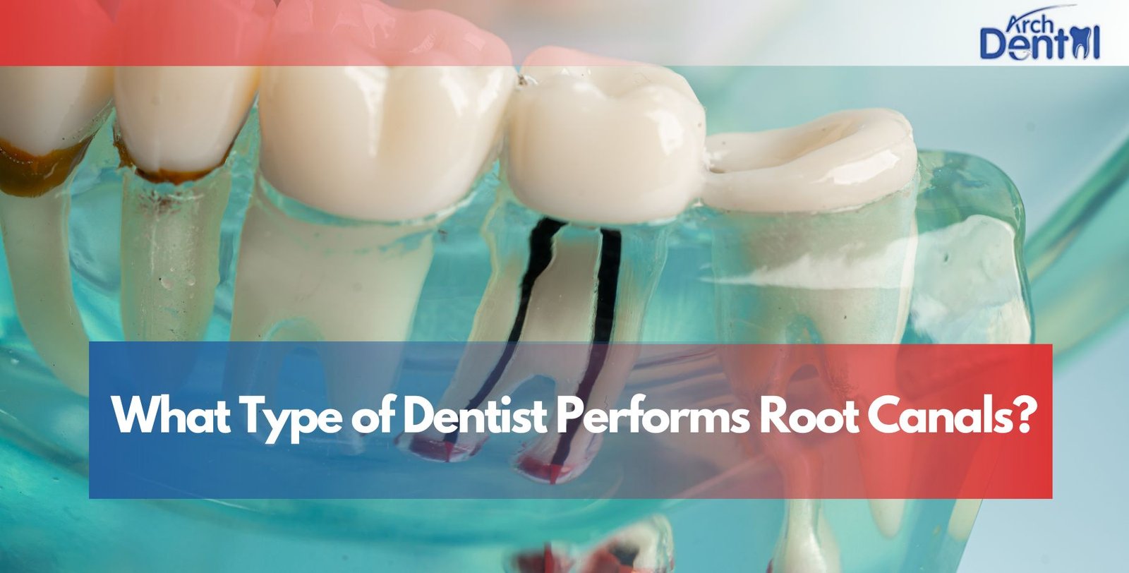 What Type of Dentist Performs Root Canals