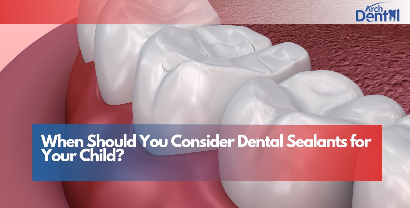 When Should You Consider Dental Sealants for Your Child