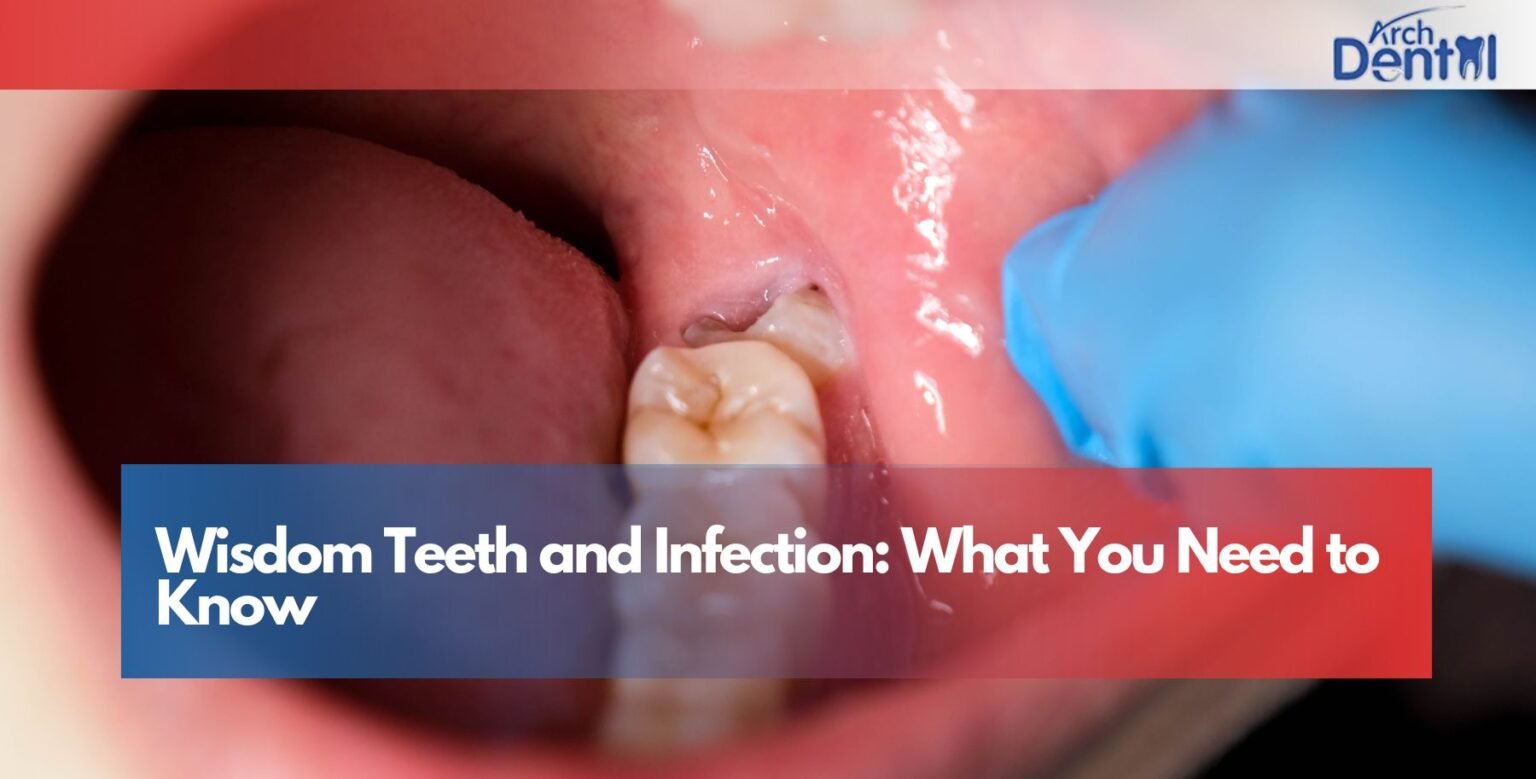 Wisdom Teeth and Infection: What You Need to Know | Arch Dental