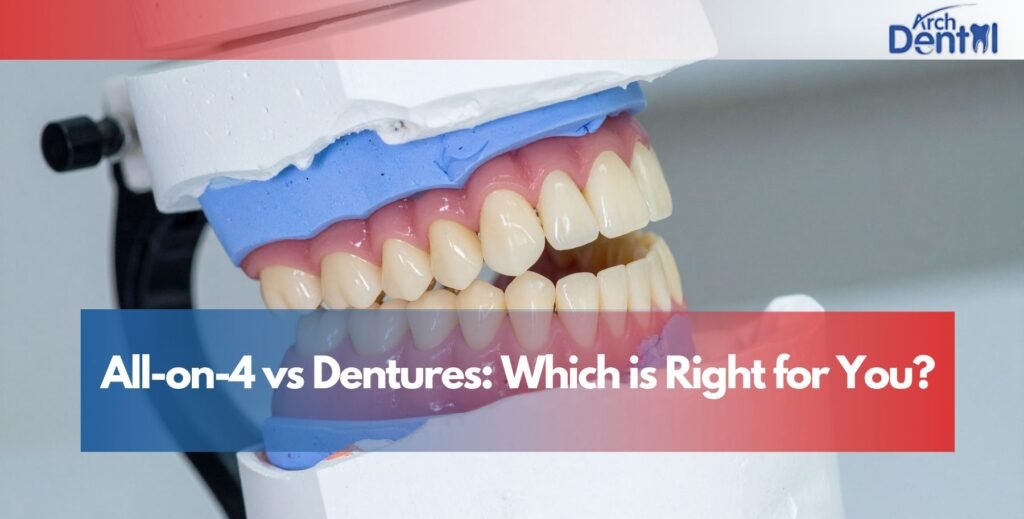 All-on-4 vs Dentures: Which is Right for You