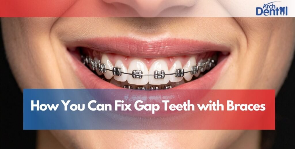 How You Can Fix Gap Teeth with Braces