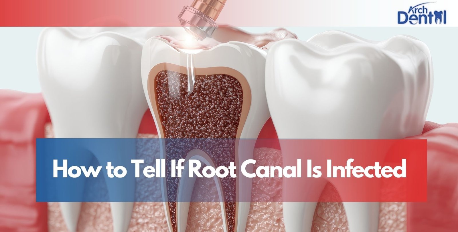 How to Tell If Root Canal Is Infected
