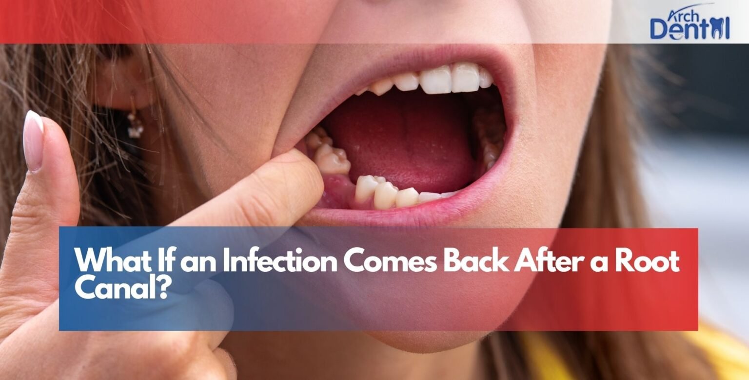 Material Back Root What If an Infection Comes Back After a Root Canal | Arch Dental